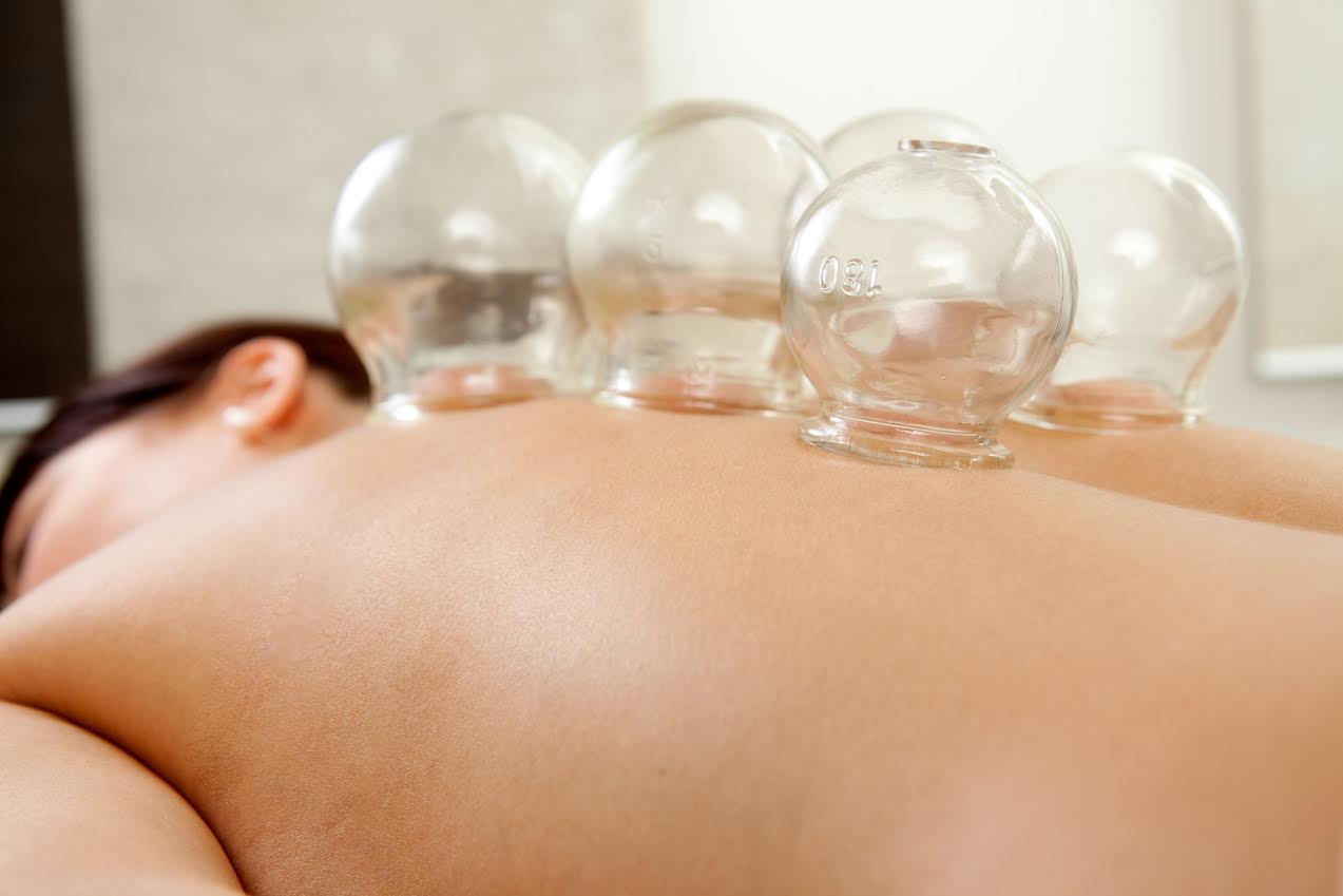 I Tried It…Chinese Cupping Therapy